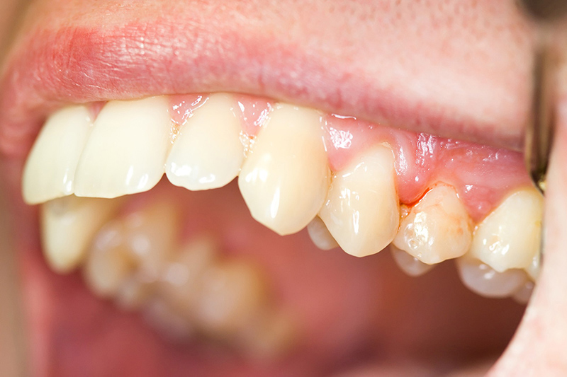 Sưng lợi khi mọc răng khôn – nguy hiểm khôn lường